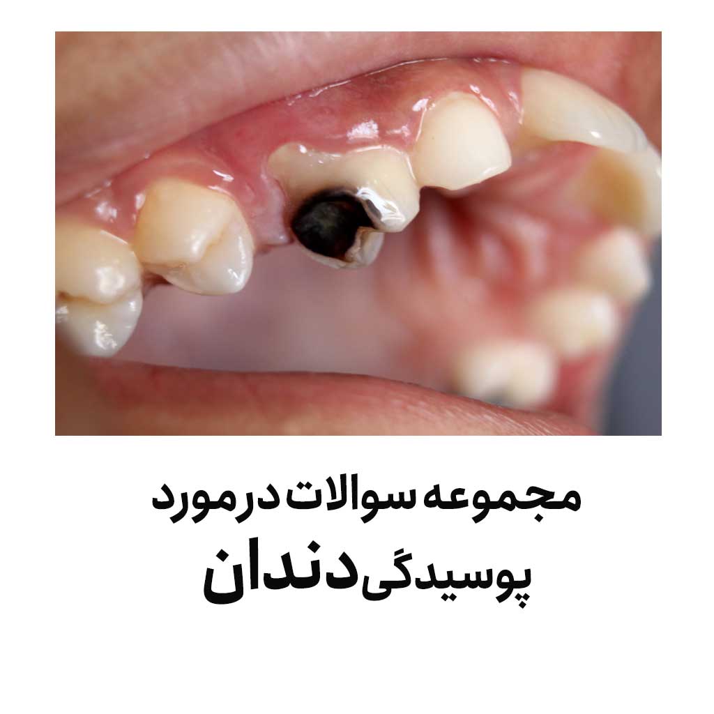 مجموعه سوالات در مورد پوسیدگی دندان